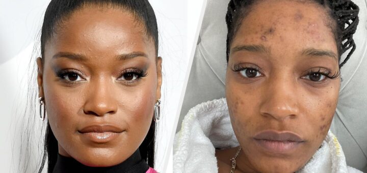 Keke Palmer sur l’acné et le syndrome des ovaires polykystiques